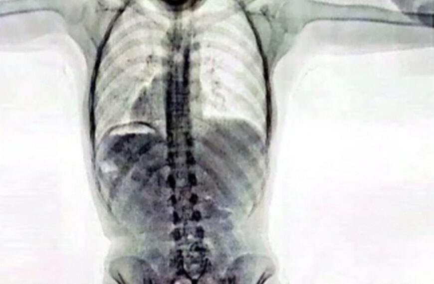 Shocking X-Ray Of Woman, 20, Caught With Cocaine Capsules In Her Private Parts