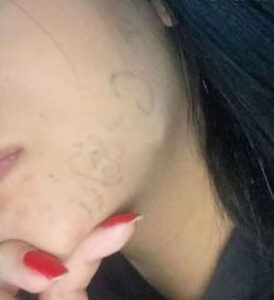 Read more about the article Teen Whose Face Was Tattooed By Sick Ex Tells Of Recovery